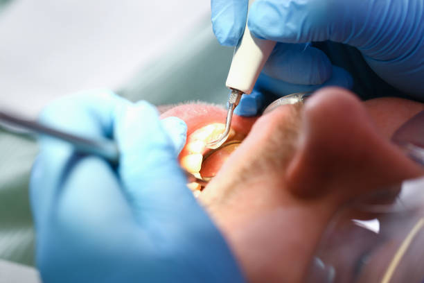 Best Emergency Tooth Extraction in Greenfield, OH