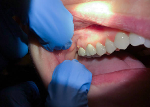 Best Emergency Wisdom Teeth Removal in Greenfield, OH
